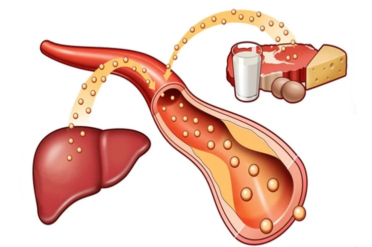 Pis xolesterolu tez və dərmansız necə azaltmaq olar?