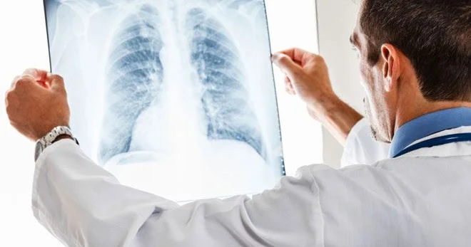 Ölkə üzrə vərəm xəstələrinin sayı açıqlandı