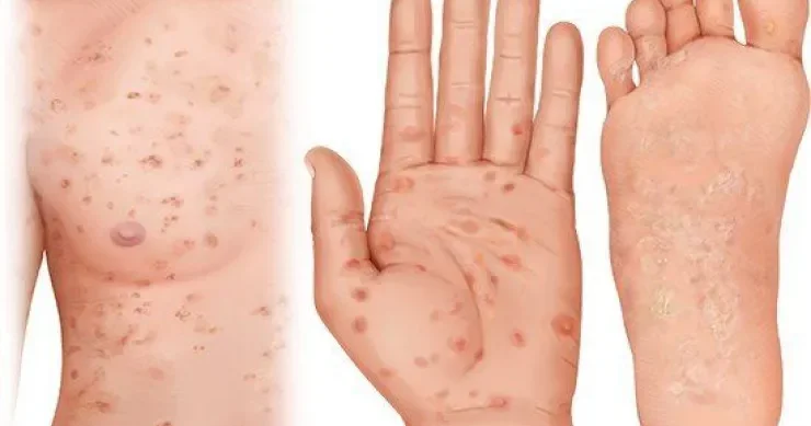 Sifilis geri döndü: Keçən əsrdən qalma infeksiya niyə yenidən güclənir?