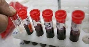 Azərbaycanda hemofiliyalı xəstələrin SAYI AÇIQLANDI