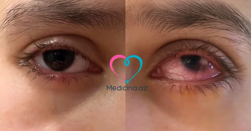 Çox şirniyyat yeyən uşağın gözü dəhşətli hala düşdü VİDEO