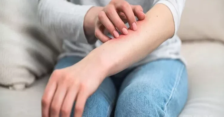 Dəriniz hissə hissə soyulur: Necə müalicə etmək olar?