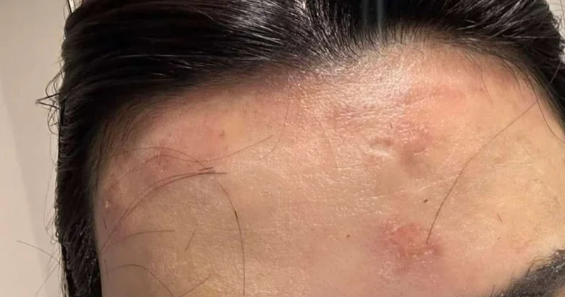 Bakıda gözəllik salonunda müştərinin alnını yandırdılar FOTO