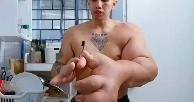 Kişinin əlləri 9 Kiloqram ağırlıqdadır Nadir sindrom