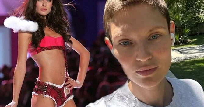 Victoria s Secret xəçəng xəstəsi olan modelin təklifini geri çevirdi
