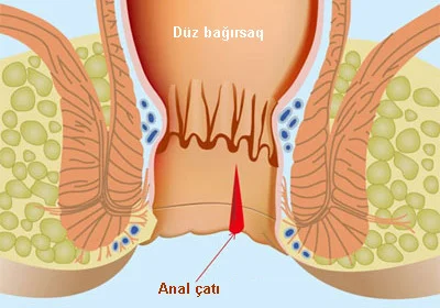 Düz bağırsaq çatları. Səbəblər və müalicə üsulları