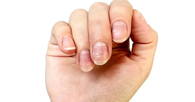 Çinko çatışmazlığı nələrə səbəb olur problemi aradan qaldırmağın yolları