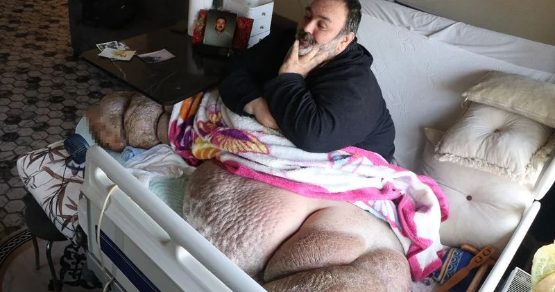 48 yaşlı kişi 300 kiloqrama çatdı: 5 ildir çölə çıxmır FOTO