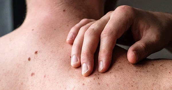 Populyar olan bu prosedur dəri xərçəngi riskini 3 dəfə artırır