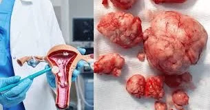 Uşaqlıqda mioma yarandısa Nə etməli?