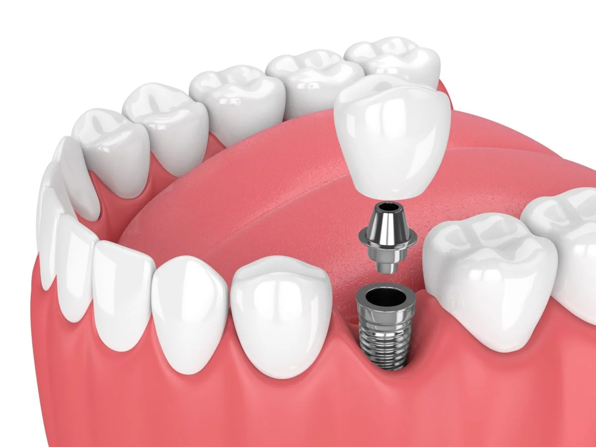 Diş implantları təhlükəlidir, ya əlverişli?