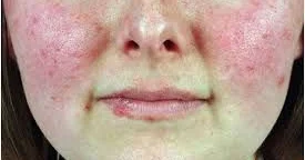 Doktor Hausun sevdiyi xəstəlik Qırmızı qurd eşənəyi necə görünür?