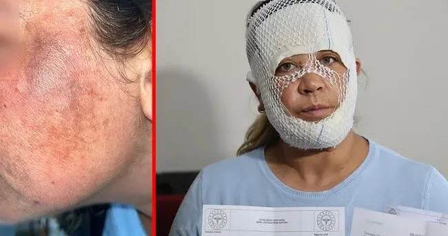 "Prenses baxımı" kabusa çevirdi Qadının üzü yandı FOTO