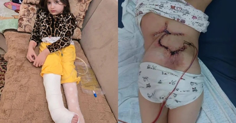 Ağır xəstəlikdən əziyyət çəkən doqquz yaşlı qızın yaraları iltihablayıb, müalicəyə ehtiyacı var