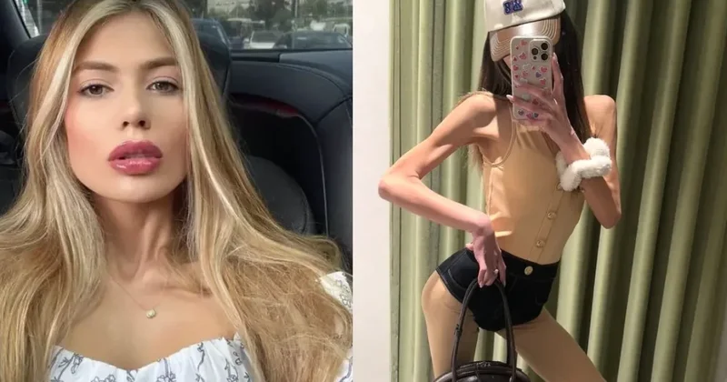 Çəkisi 23 kq ya düşən Nihal vəfat etdi FOTOLAR