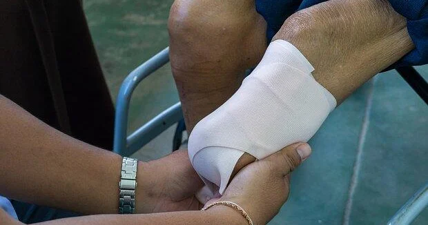 Мужчина потерял ногу из за поедающей плоть бактерии