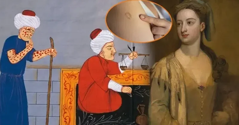 Çiçək xəstəliyinə qarşı peyvəndin izi Osmanlıya gedib çıxır!