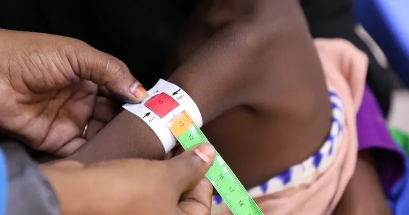 Humanitar yardımın kəsildiyi Somalidə uşaqlar qida çatışmazlığı ilə üzləşib