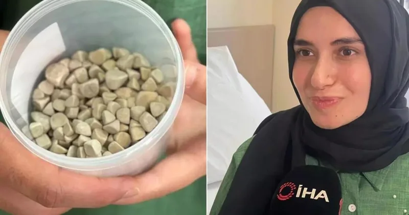 21 yaşlı Fatmanın bədənindən 287 daş çıxarıldı tibb aləmi şokda FOTO