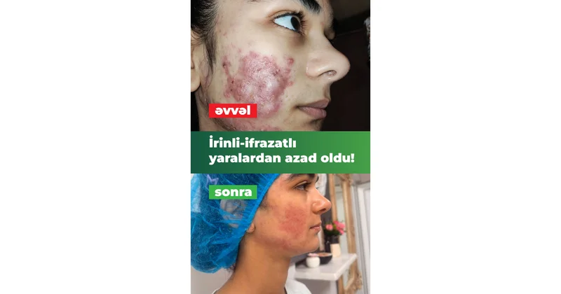 İltihablı sızanaqlar yeniyetmənin həyatını alt üst etmişdi. İnteqrativ müalicə ilə həll yolu tapıldı VİDEO