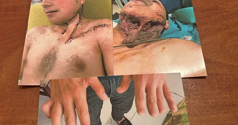 44 günlük müharibədə bu vəziyyətə düşən 24 yaşlı keçmiş əsgərə əlillik və pensiya verilməyib