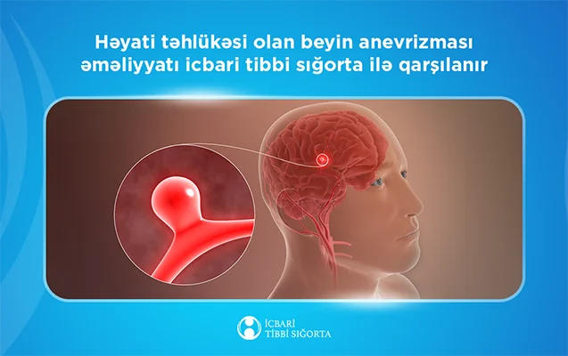 Beyin anevrizması əməliyyatı icbari tibbi sığorta ilə qarşılanır