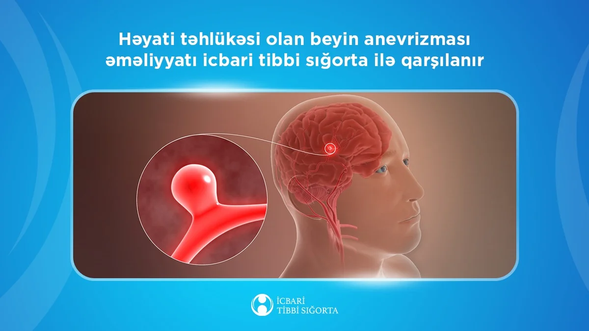 Beyin anevrizması əməliyyatı icbari tibbi sığorta ilə qarşılanır Azərbaycanda özəl xəbərlər, araşdırmalar, təhlillər və müsahibələrin tək ünvanı