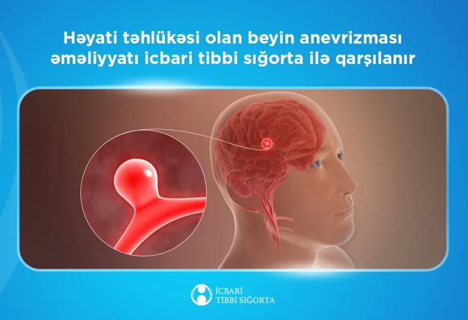 Həyati təhlükəsi olan beyin anevrizması əməliyyatı icbari tibbi sığorta ilə qarşılanır AZƏRTAC