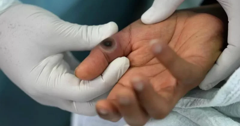 В одном из индийских штатов выявлен новый опасный вариант оспы обезьян