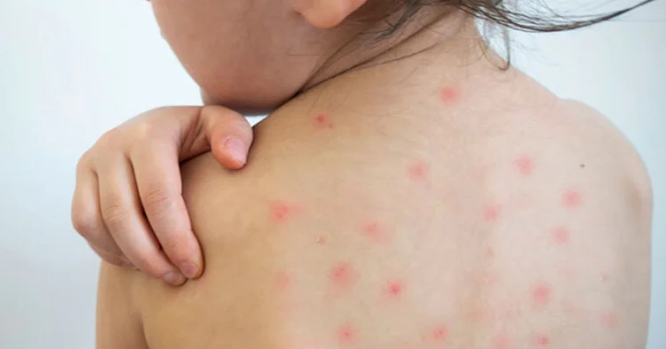 Вспышка кори в Казахстане Minval Politika