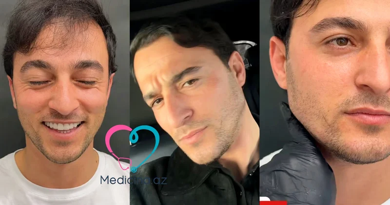 İqo üzünə estetik prosedur etdirdi VİDEO