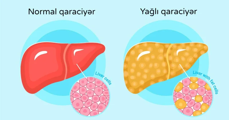 Hormon Qaraciyər Piylənməsi Xəstəliyini Geri qaytara bilər
