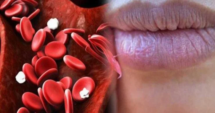 Anemiyanın qarşısını necə almaq olar? Həkim DANIŞIR