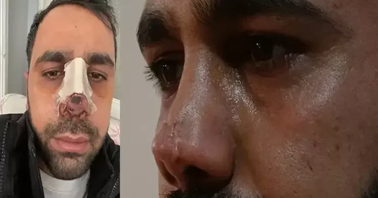 İkinci dəfə estetik əməliyyat olunan kişinin burnu çürüdü