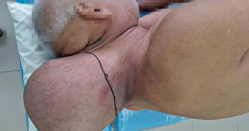 Həkimlər möcüzə yaratdı 65 yaşlı kişidən baş böyüklüyündə şiş uğurla çıxarıldı FOTO