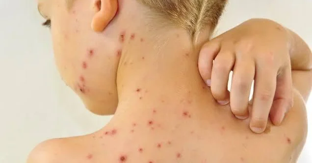 Qızılca ilə bağlı son vəziyyət açıqlandı RƏSMİ