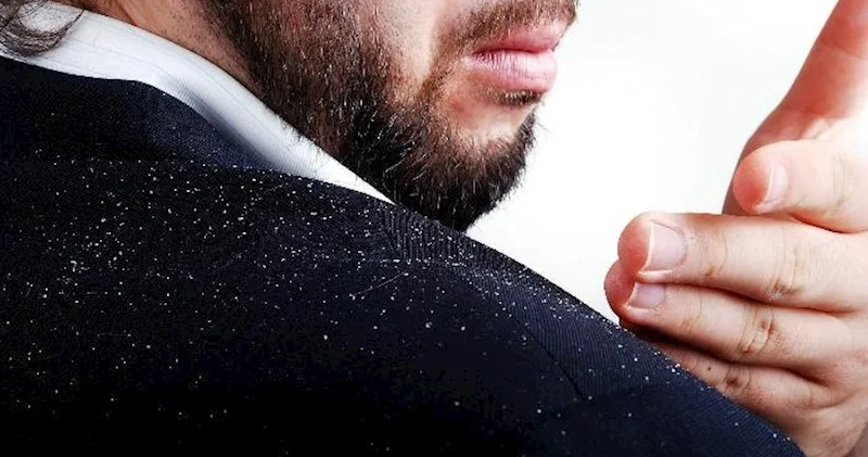 Qış gəlməmiş niyə kəpək artır?