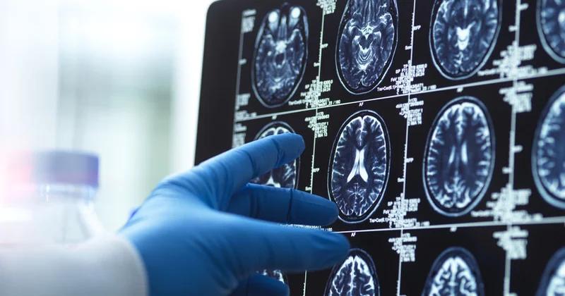 Psixiatr: Alkoqol beyin həcmini kiçildir və idrakı zədələyir