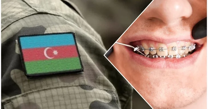 Брекеты в тренде: дают ли они отсрочку от армии в Азербайджане?