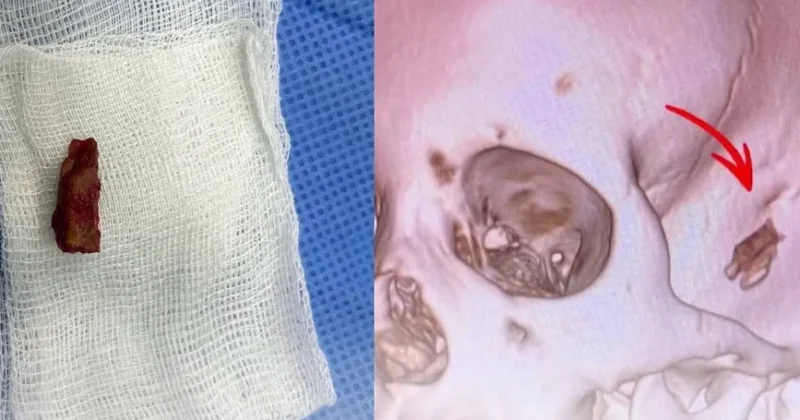 Beş ildən sonra uşağın baş nahiyəsində budaq parçası aşkar ediblər