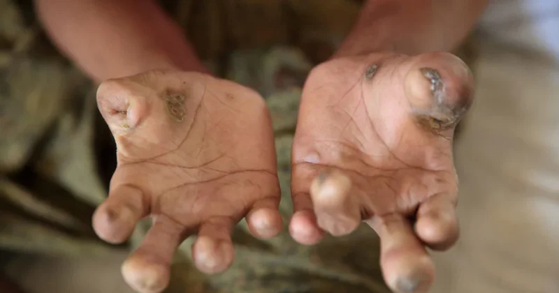 44 il sonra bir ilk: İki Avropa ölkəsində nadir xəstəlik aşkarlandı