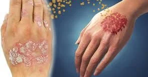 Psoriaz və ya pullu dəmrov Niyə tam sağalmır?