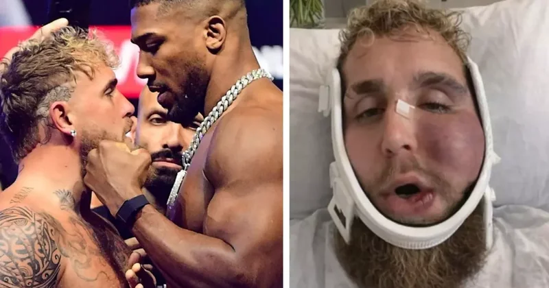 Çənəsi sındı, amma 92 milyon dollar qazandı FOTO