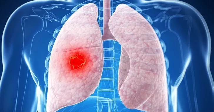 Азербайджанские эксперты рассказали, как быстро может распространяться пневмония