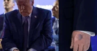 Trampın əlləri buna görə göyərib