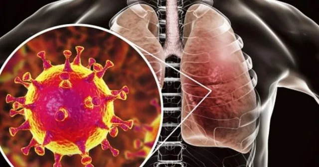 Pnevmoniya sürətlə yayılır? İnsanların gec sağalma SƏBƏBLƏRİ