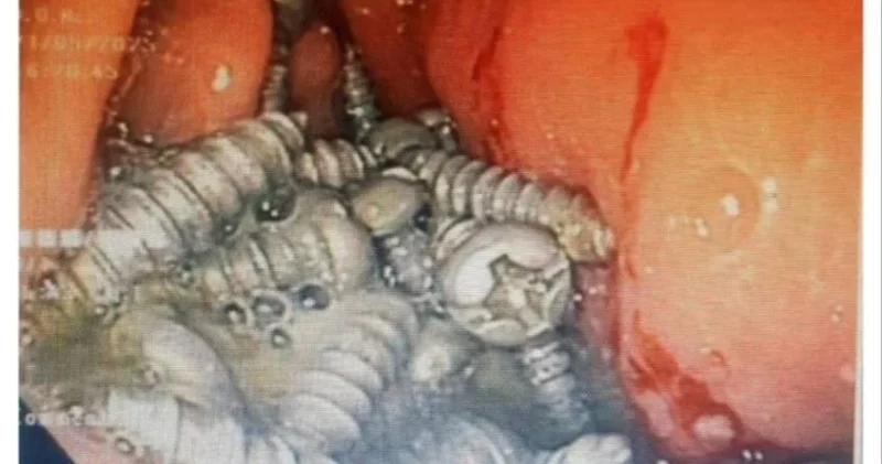 Yaşlı kişinin mədəsindən 50 ə yaxın metal vint çıxarıldı