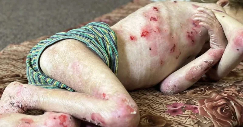 Qəzzada uşaqlar aclıq və xəstəliklə mübarizə aparır FOTO