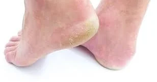 Dabanımız niyə çatlayır? Bunu edərək qarşısını ala bilərik