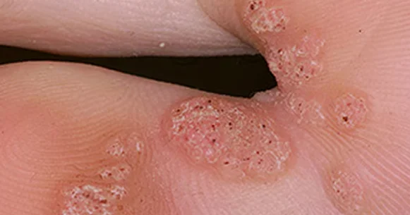 Azərbaycanda ölümcül virus yayılıb: Peyvəndləmə vacibdir